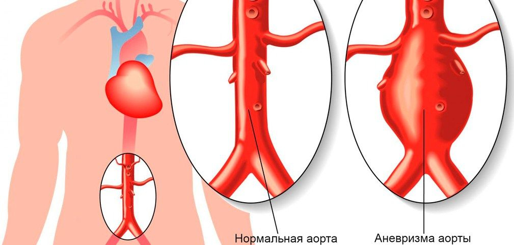 давящая боль в области сердца